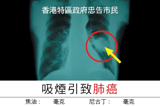 Hong Kong 2007 Health Effects lung - internal image, lung cancer, chinese